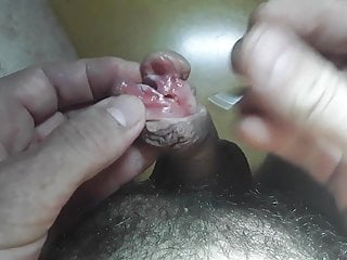 Insightful et subincision